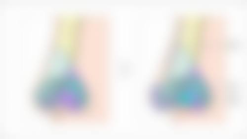 眼袋手术两侧不对称能否修复?手术修复有办法