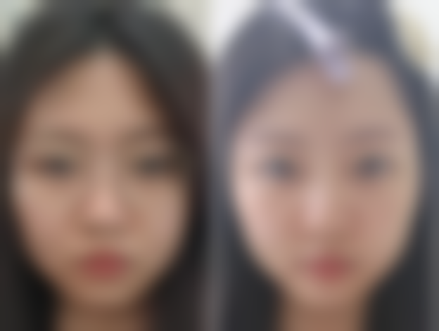 双眼皮术后留疤不用怕！非手术治疗方案来啦