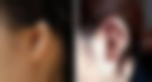 假体隆胸：水滴形与圆形通用选择及术后护理