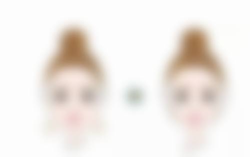 自体脂肪丰太阳穴真的好吗？术后效果自然持久，取材易无排异优势尽显！ 