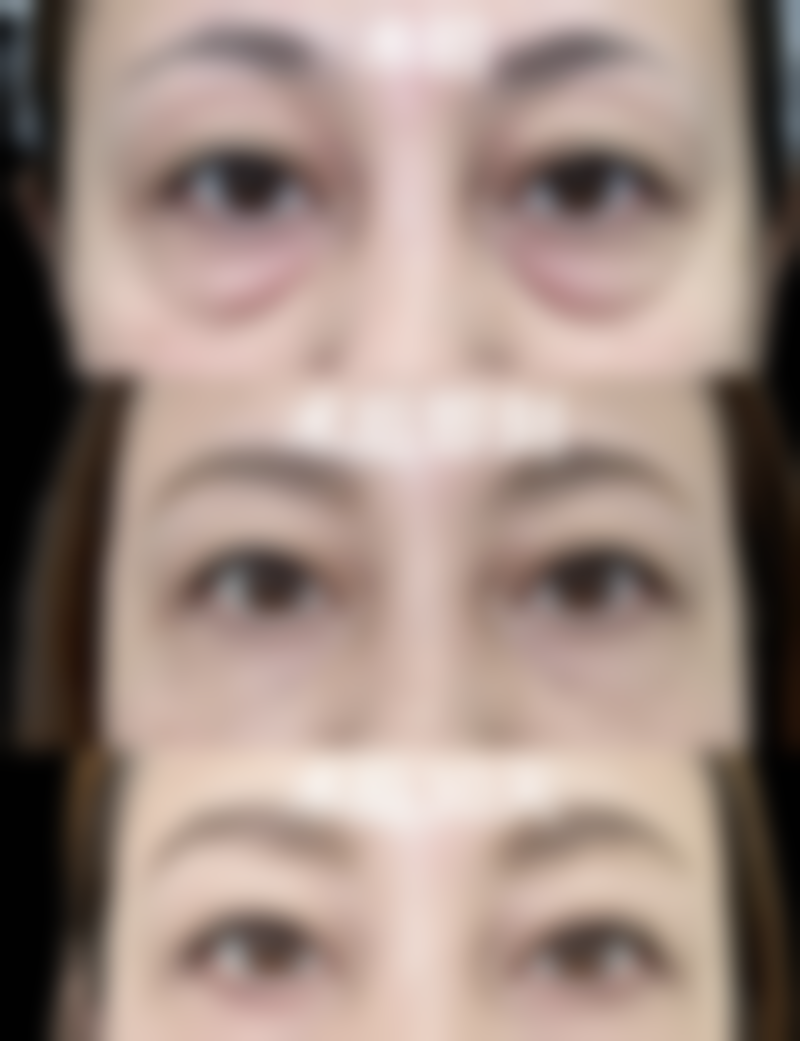 如何睡出迷人双眼皮？睡眠时长与质量的影响