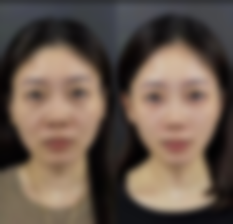 大腿吸脂后多久能消肿？揭秘各阶段消肿时间，掌握加速消肿护理秘籍