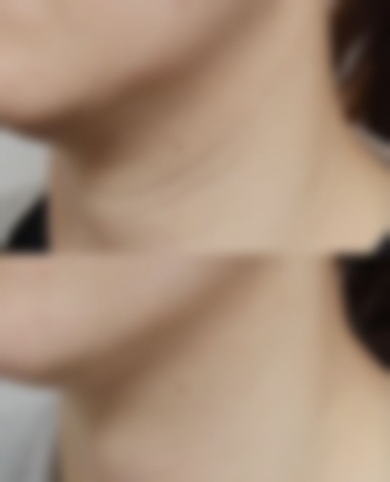 脸上有疤怎样快速消除?手术及其他治疗有门道