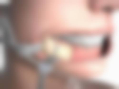 双眼皮术后何时能洗脸？总结与建议