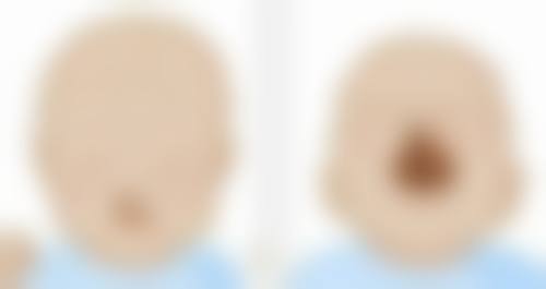 如何巧除疤痕疙瘩？多种疗法定制方案，治愈率高达 95%还注重前期预防 