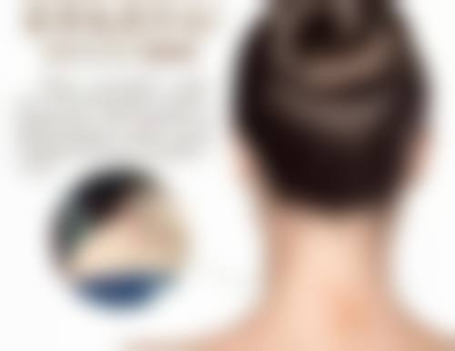 巧除疤痕疙瘩：前期预防的重要性