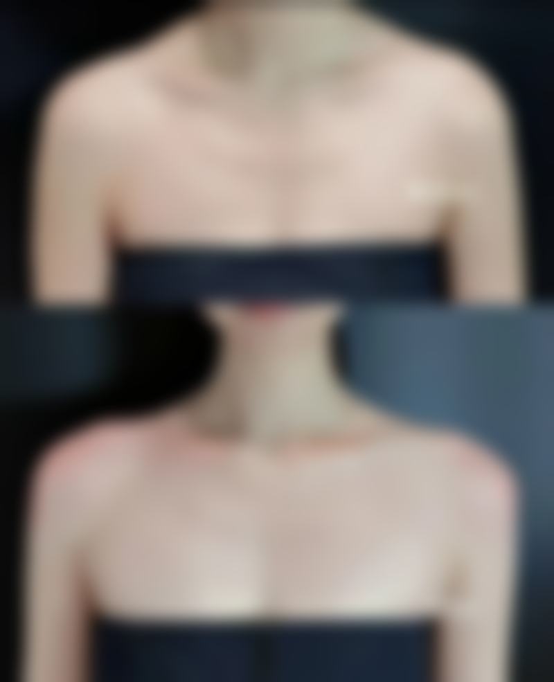 瘦脸针100U：剂量对比与风险优势