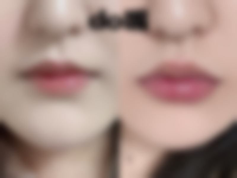 宝宝脸上冻疮疤痕怎么去除？多种科学方法齐上阵，淡化印子修复肌肤焕新生 