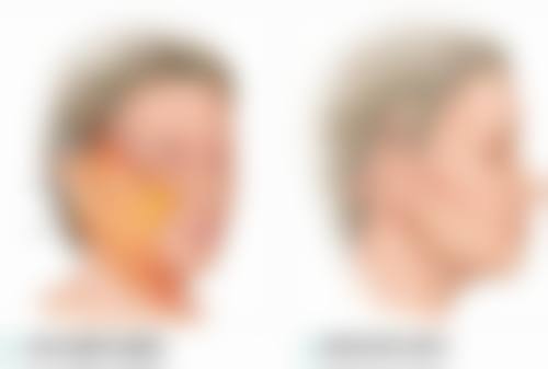 20岁有眼袋，物理治疗来帮忙