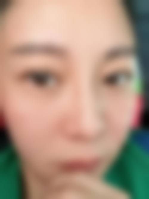 五、沈阳显赫植发医院实例