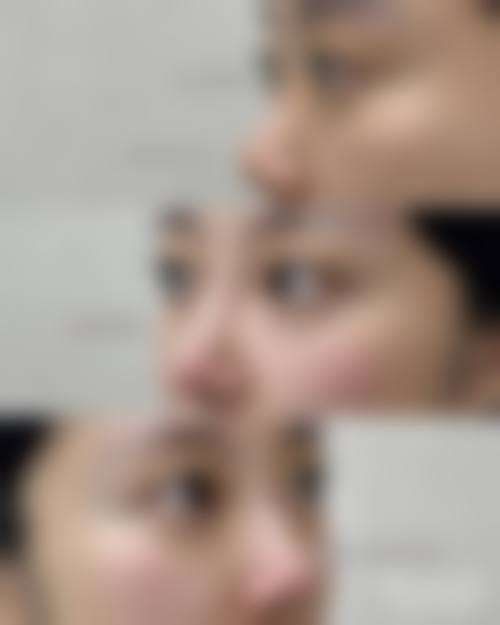 五、福州周江衡爱凝隆美尔整形医院实例