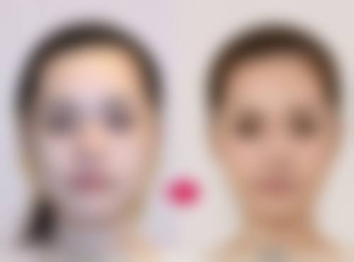 怎样更有效去眼袋？了解临床眼袋分型及对应解决方法