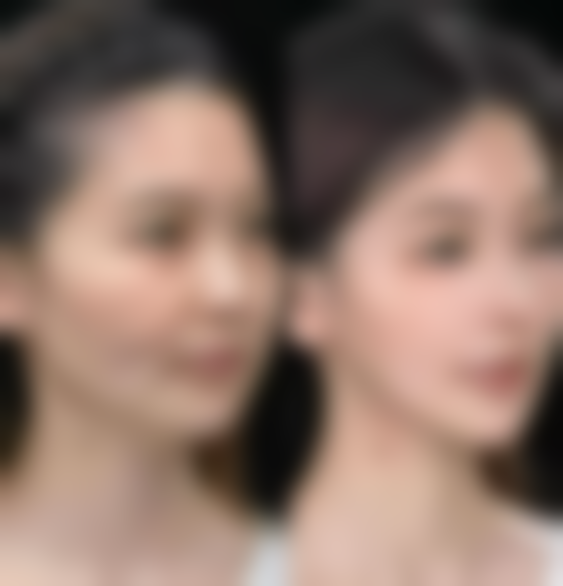 丰太阳穴选什么方法好？线提升提升与自体软骨移植的特色