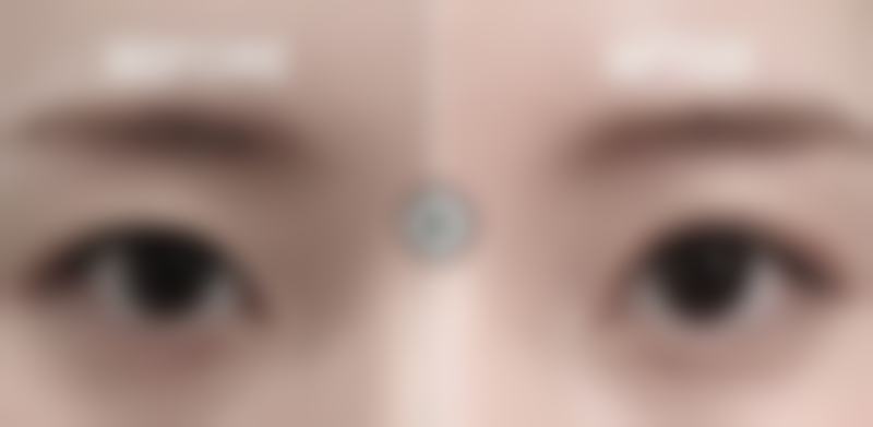 激光治疗：腿上疤痕色素沉着去除的效率高手段