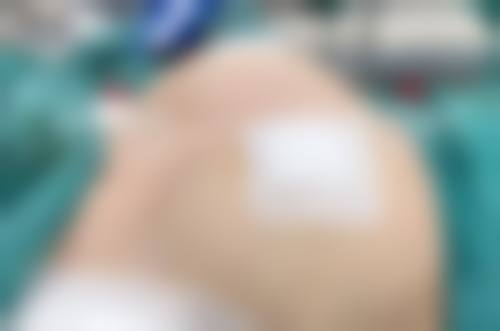 五、河南郑州美昂整形实例