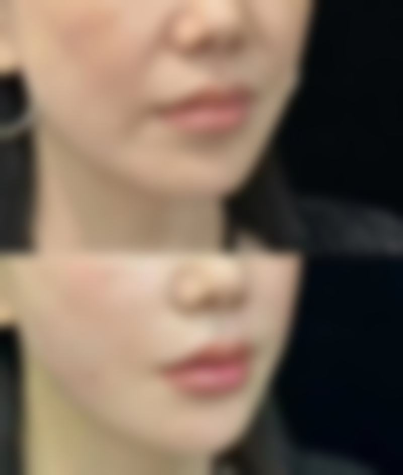 割完双眼皮,术后护理促进修复的要点