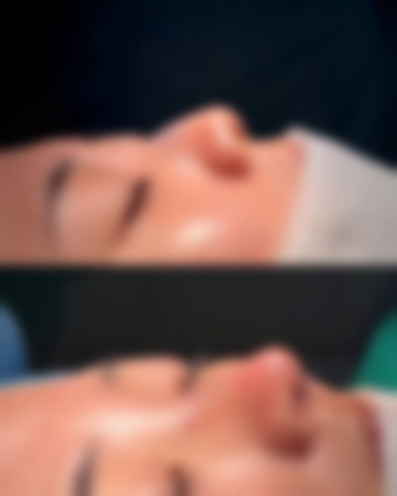 割完双眼皮,特殊修复情况说明