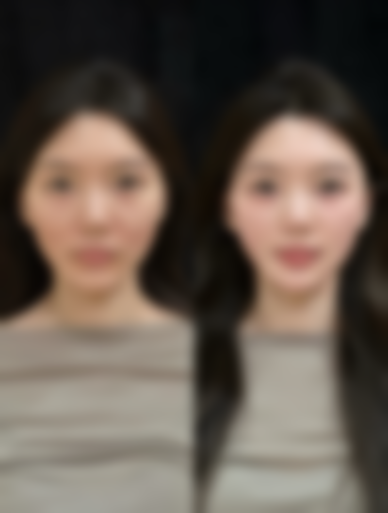 手术修复，重塑自然美鼻