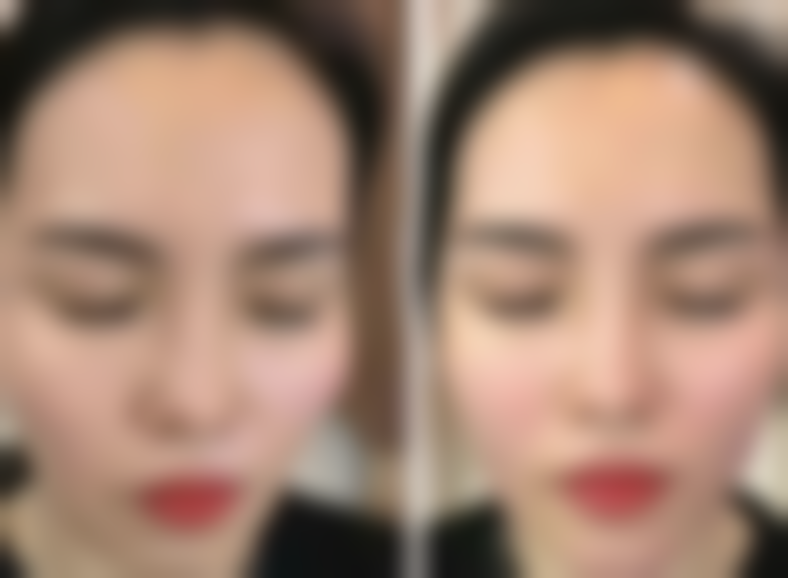 选正规机构、适配假体,多举措降低风险提升满意度之适配假体是核心