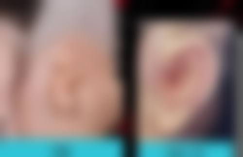 隆鼻打什么消炎针成效至佳？喹诺酮类消炎针适用特殊情况