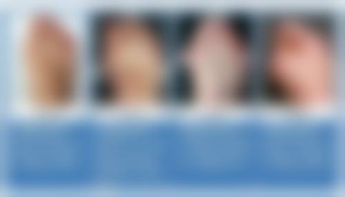 假体隆胸移位啥感觉？或有疼痛异物感，还会致外形异常、活动受限！ 