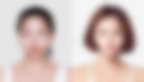 隆鼻打什么消炎针成效至佳？大环内酯类消炎针适合过敏人群