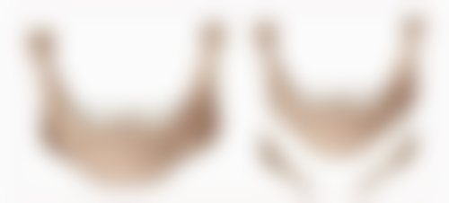 隆鼻打什么消炎针成效至佳？术后消炎针使用及护理要点