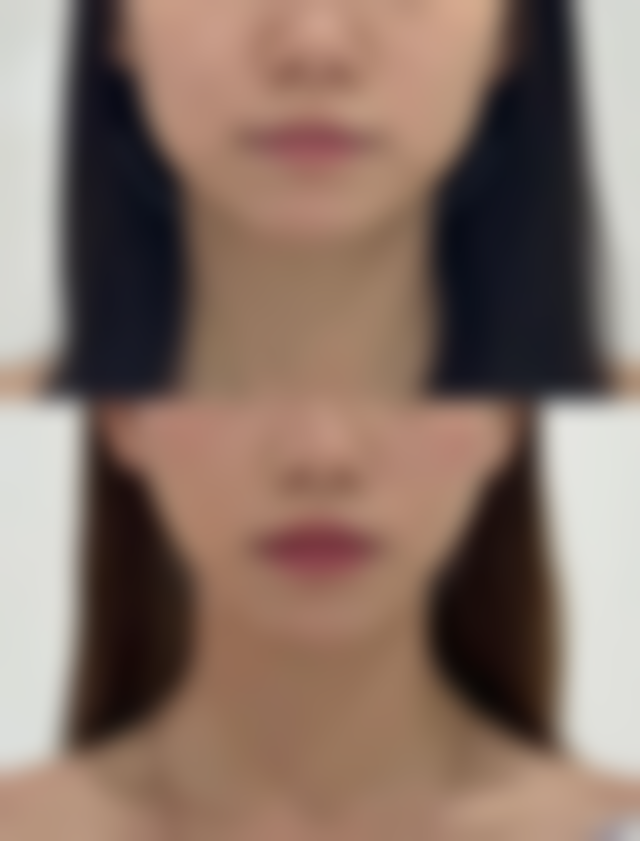 隆鼻打什么消炎针成效至佳？其他抗感染药物的辅助作用