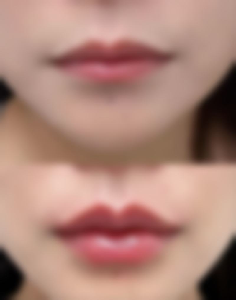 隆胸假体破裂会怎样？乳房外观会有啥变化？