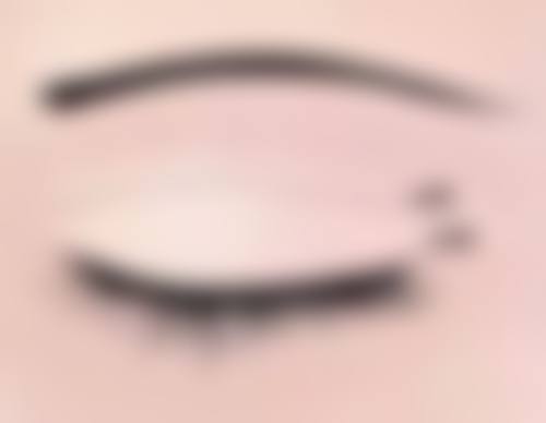 如何巧妙去除双眼皮肉条感?分析肉条感形成的原因