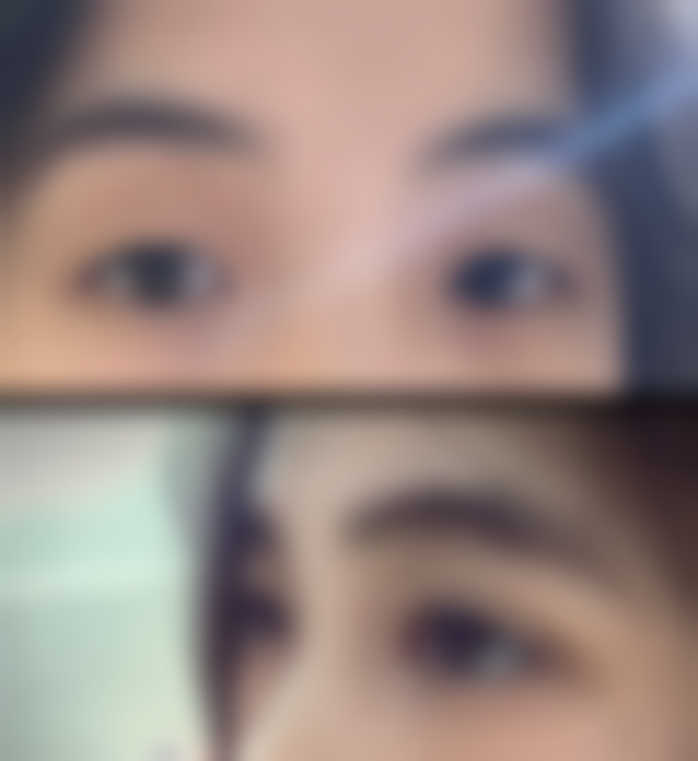 瘢痕疙瘩难以有效治疗？辅助护理不能少，长期管理见成效