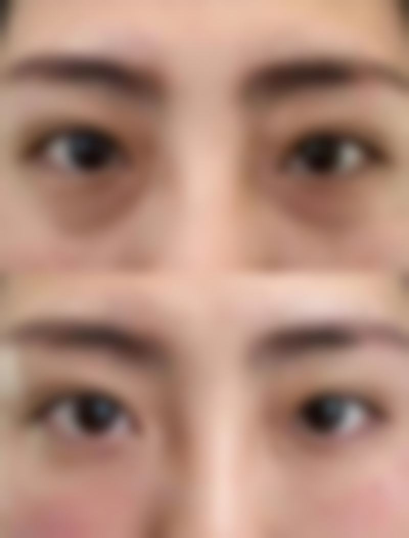 割双眼皮后吃草莓,注意食用细节