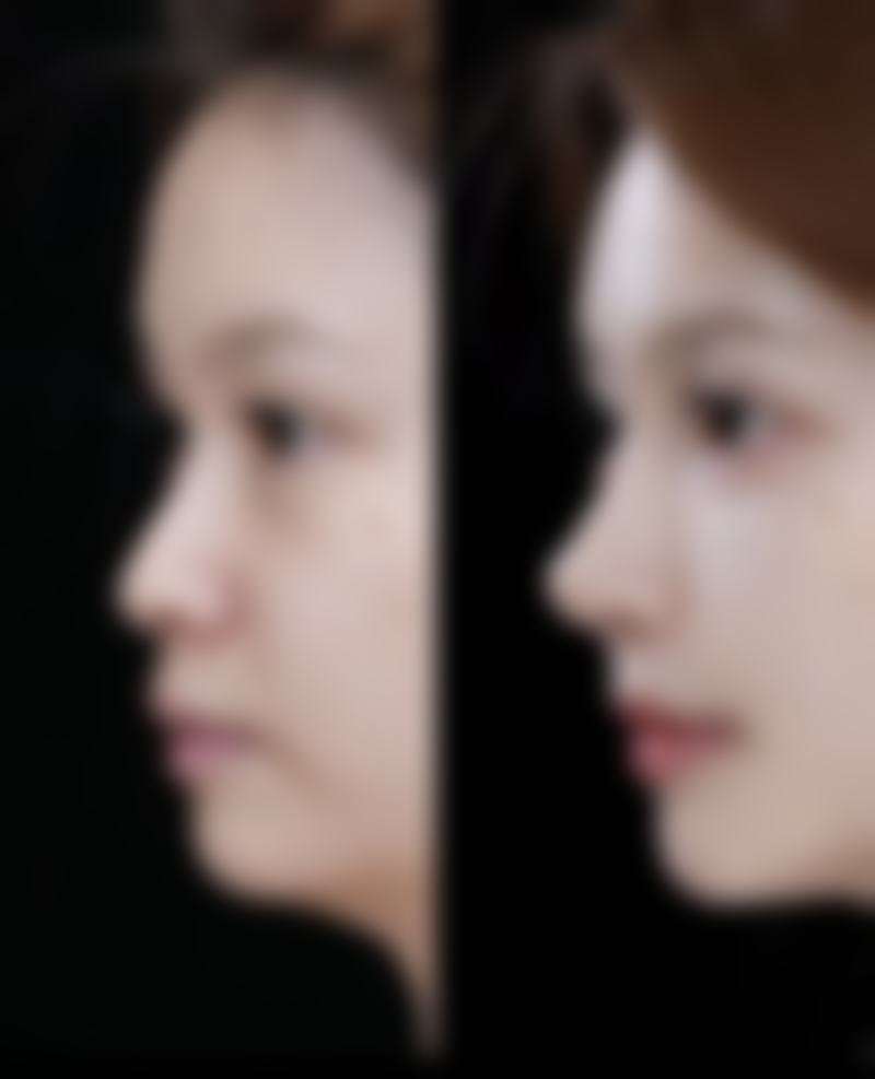 四、深圳康雪迩整形实例