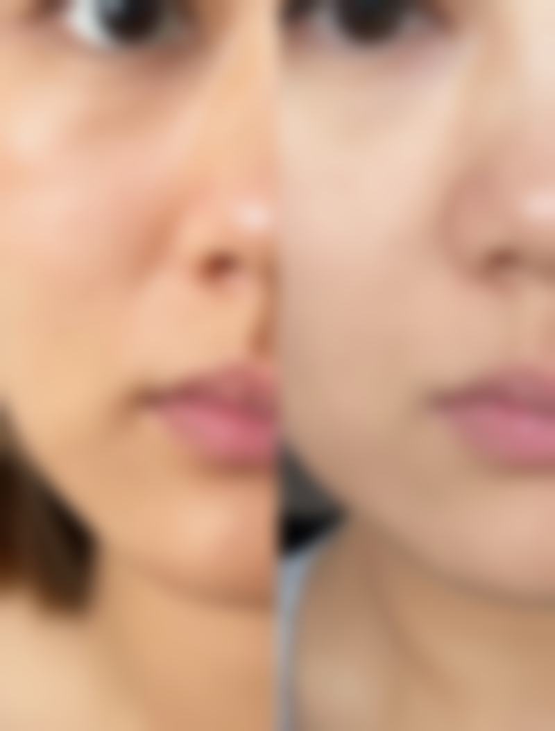 怎样去除眼袋最有效？多种方法精准适配不同类型眼袋，安全高效恢复快 