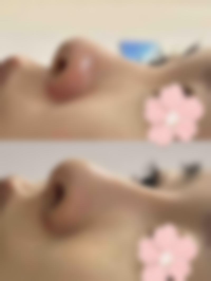 总结隆鼻后捏鼻子的整体情况