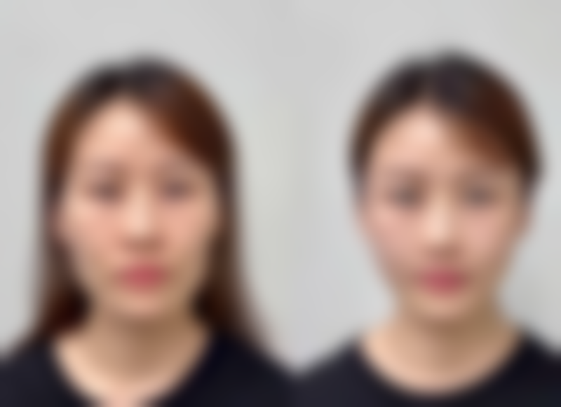 分享隆鼻后捏鼻子的正确方式