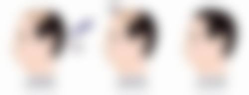 疤痕疙瘩究竟能否去掉？多种疗法联合出击，降低复发率改善外观有妙招 