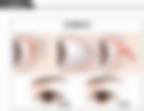 双眼皮后多久能修复自然？完全修复自然阶段