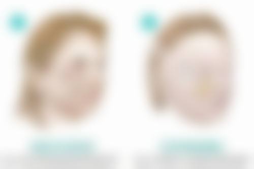 肋骨隆鼻多久能恢复？3个月左右基本恢复，护理与体质影响恢复时长 