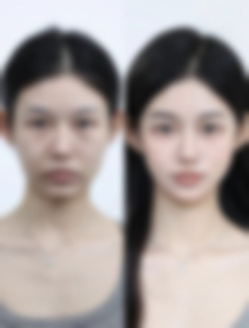 如何加快肋骨隆鼻的修复速度？