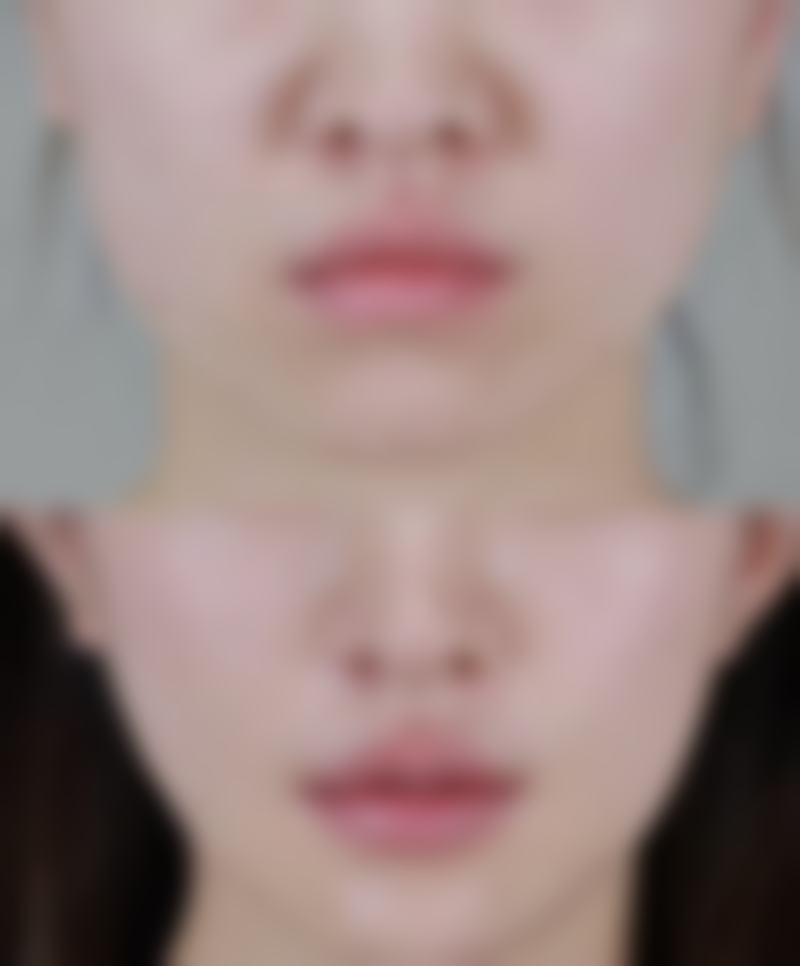 影响肋骨隆鼻修复时长的因素有哪些？