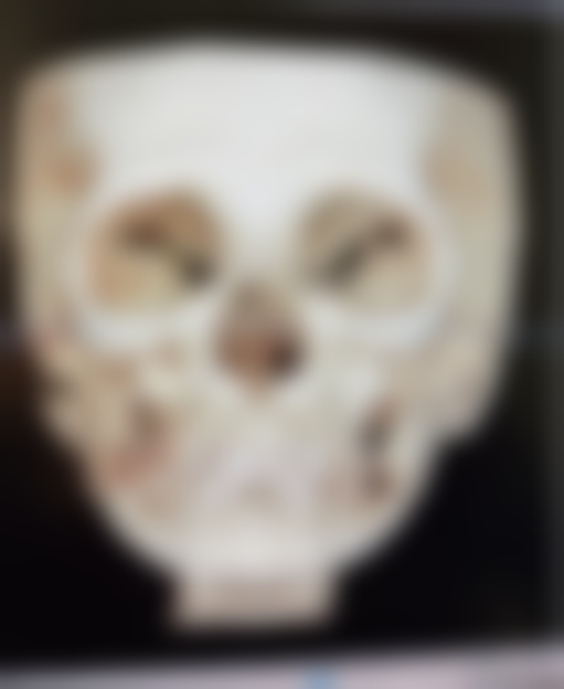 长期被黑眼袋困扰是咋回事？外界与护理因素有影响