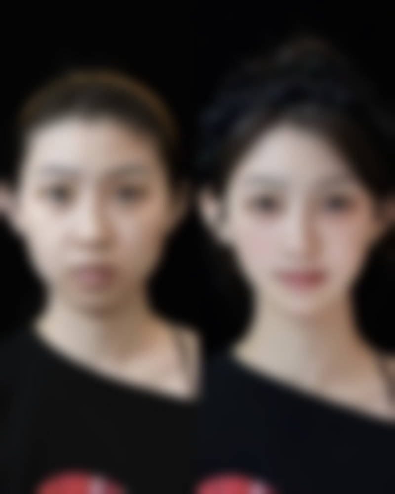 眼睛被眼袋困扰怎么办？多种治疗手段+日常护理，还你明亮紧致双眸 