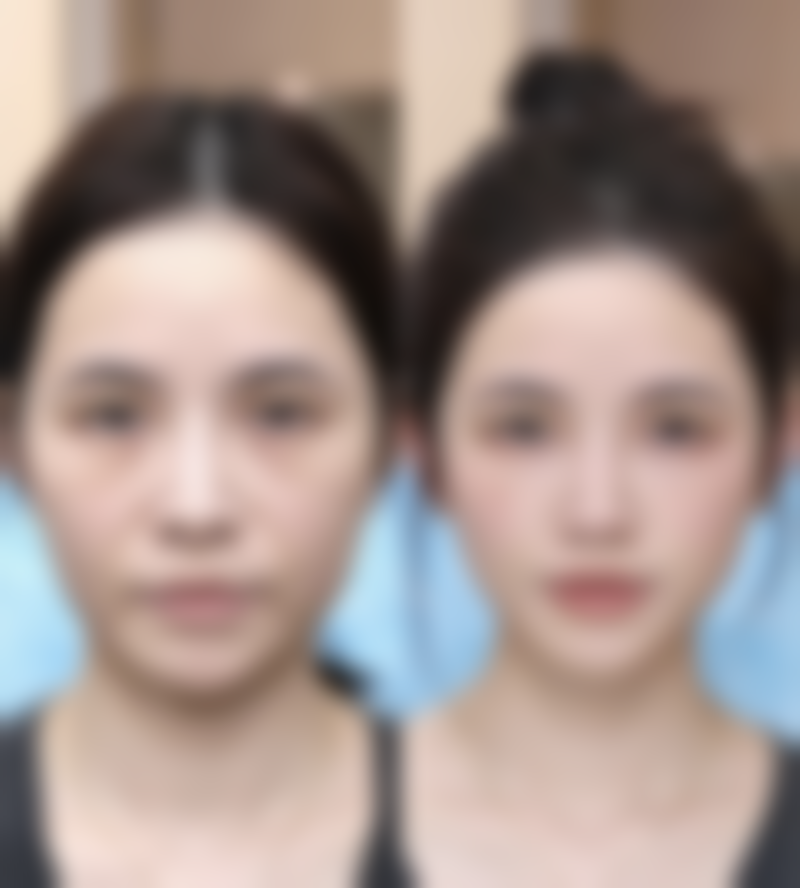 超体隆鼻与膨体隆鼻：适用人群大不同