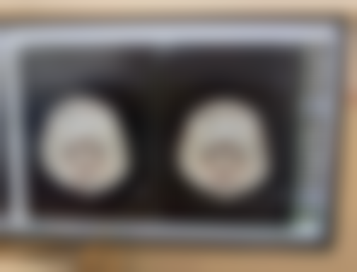 超体隆鼻与膨体隆鼻：专精医生怎么看