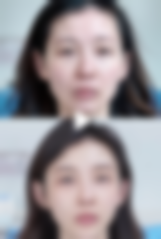 超体隆鼻与膨体隆鼻：收费情况早知道