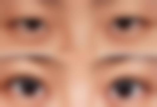 如何巧妙清除眼袋？物理治疗与医疗美容技术显神通