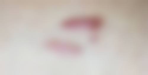 五、新乡医学校第三附属医院皮肤科实例