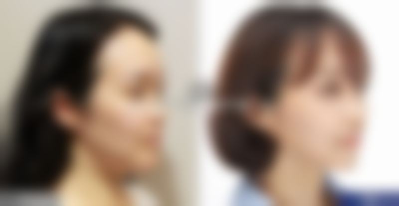 如何巧妙清除眼袋？药物治疗来帮忙