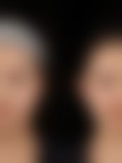 四、郑州广美整形美容医院实例